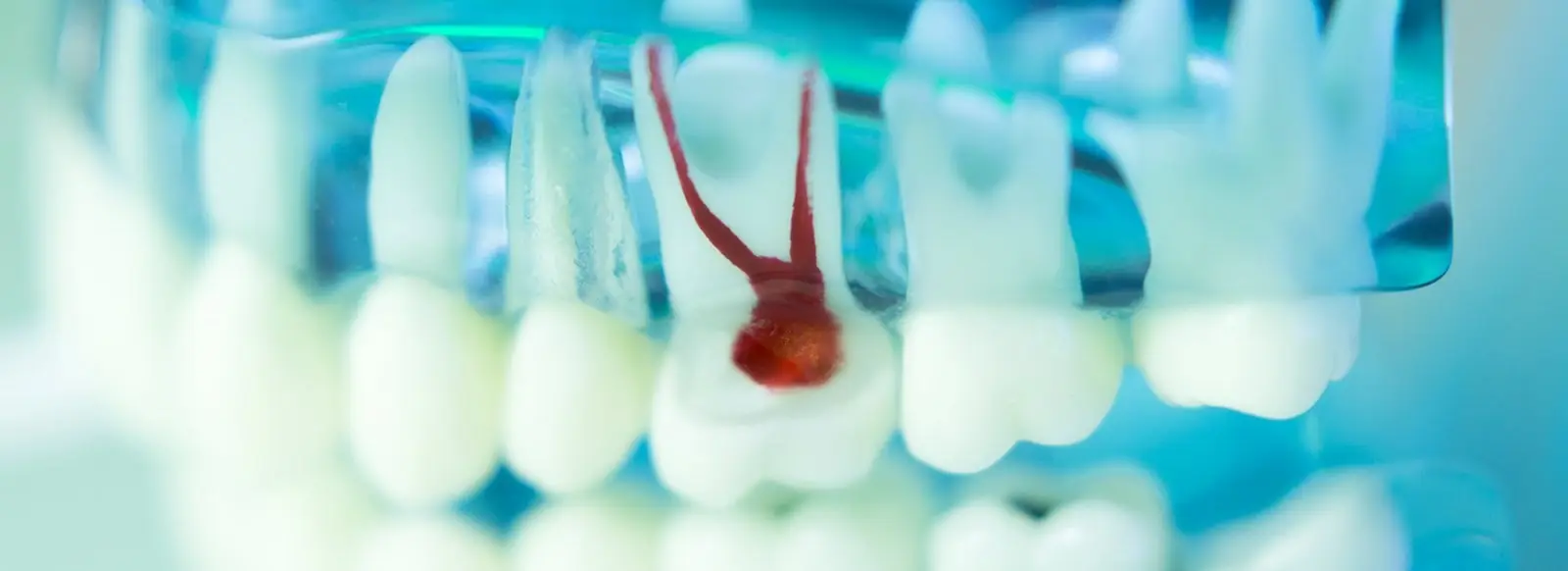 Clear dental model showing a tooth cross section with the root canal and pulp highlighted in red.